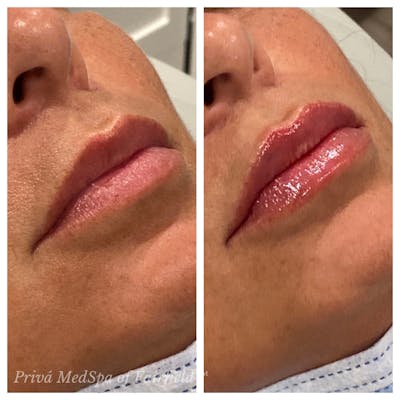 Lip Augmentation Before & After Gallery - Patient 30343125 - Image 1