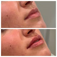 Lip Augmentation Before & After Gallery - Patient 36297007 - Image 1