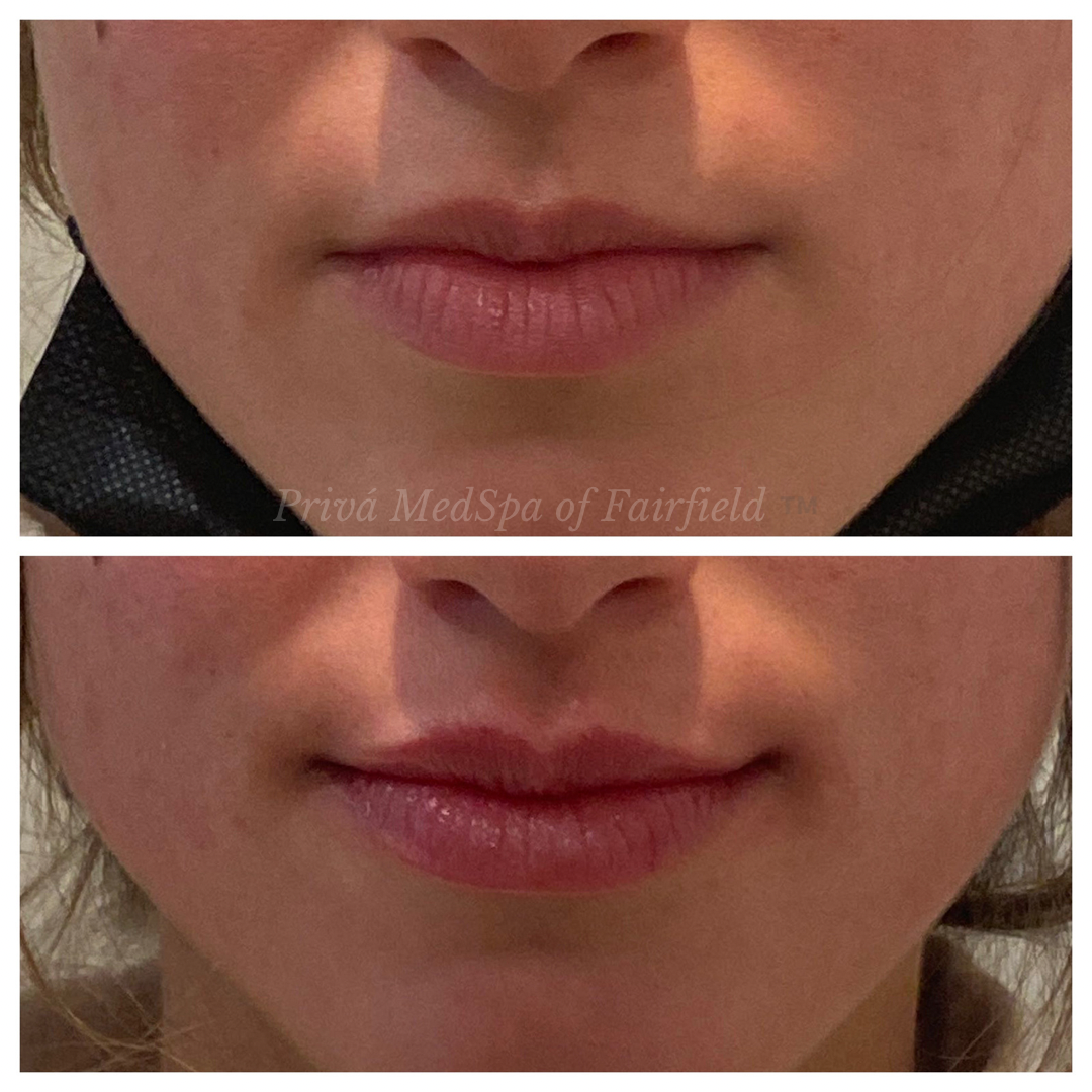 Lip Filler B/A