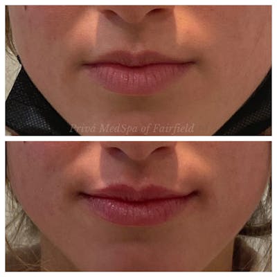 Lip Augmentation Before & After Gallery - Patient 36297007 - Image 2