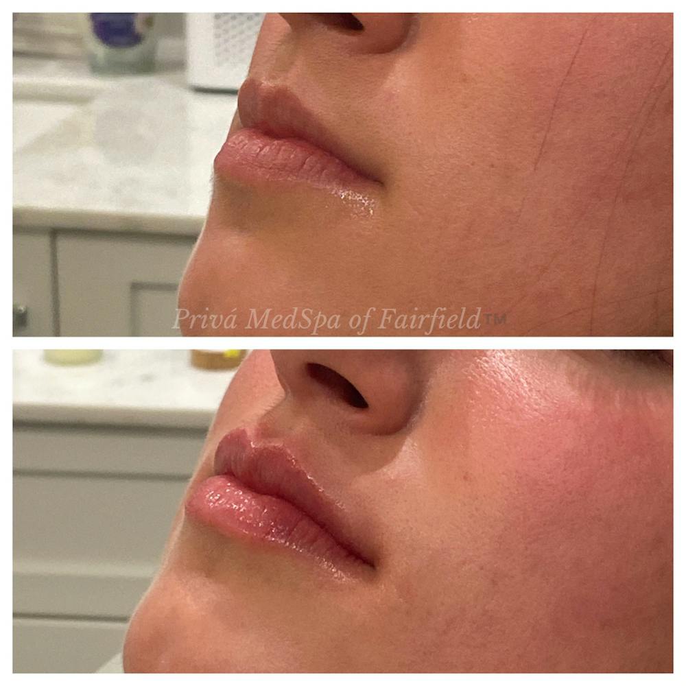 Lip Augmentation Before & After Gallery - Patient 36297007 - Image 3