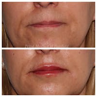Lip Augmentation Before & After Gallery - Patient 45006213 - Image 1