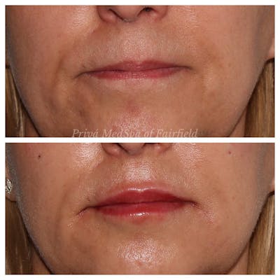 Lip Augmentation Before & After Gallery - Patient 45006213 - Image 1