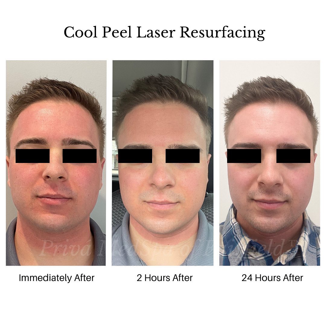 Before and After Laser Skin Resurfacing in Westport