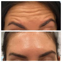 Botox/Dysport/Jeuveau Before & After Gallery - Patient 45215588 - Image 1