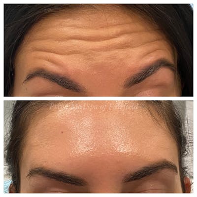 Botox/Dysport/Jeuveau Before & After Gallery - Patient 45215588 - Image 1