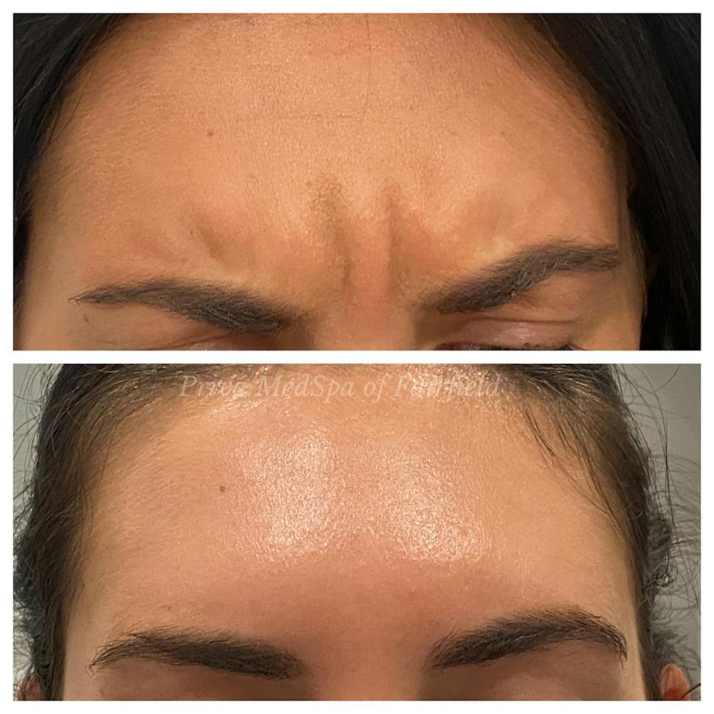 Botox/Dysport/Jeuveau Before & After Gallery - Patient 45215588 - Image 2