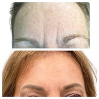 Botox/Dysport/Jeuveau Before & After Gallery - Patient 45215589 - Image 1