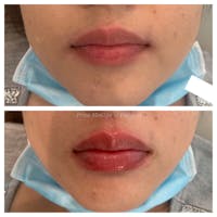 Lip Augmentation Before & After Gallery - Patient 45215637 - Image 1