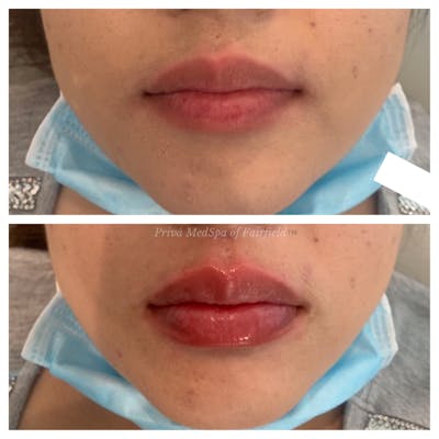Lip Augmentation Before & After Gallery - Patient 45215637 - Image 1