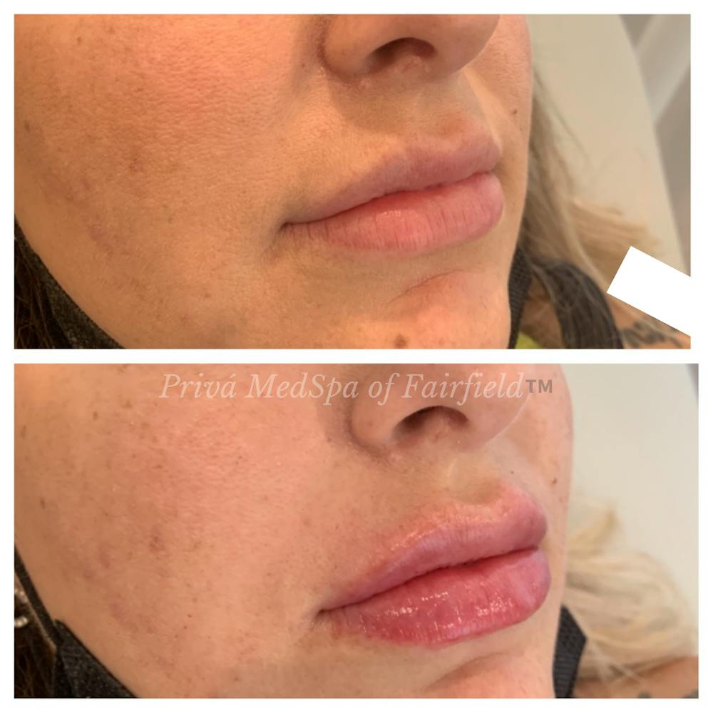 Lip Augmentation Before & After Gallery - Patient 45215638 - Image 1