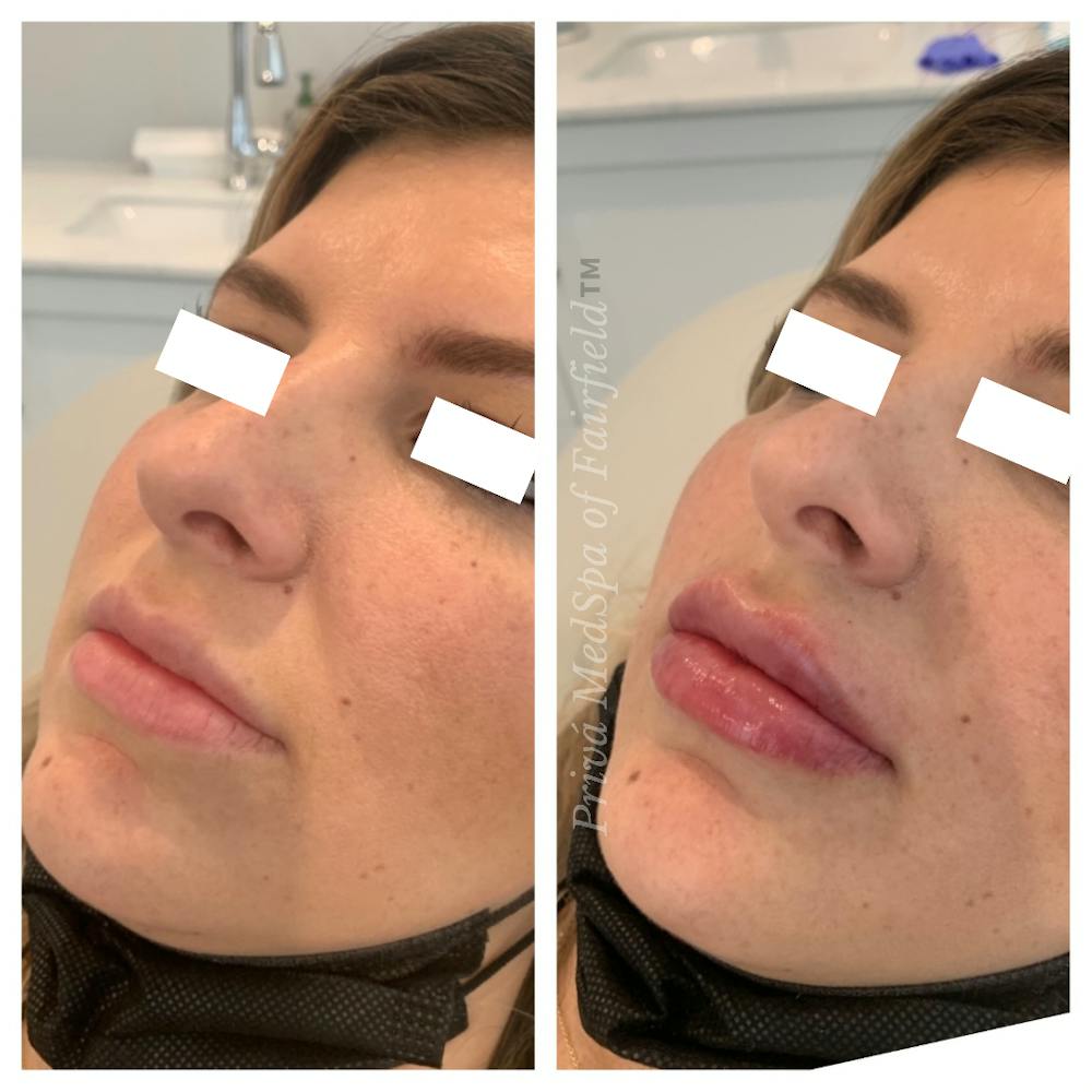 Lip Augmentation Before & After Gallery - Patient 45215638 - Image 2