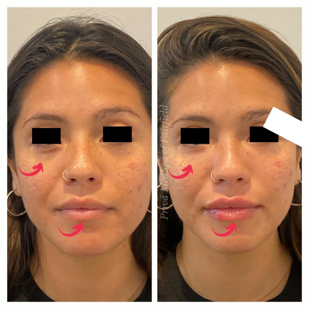 Tear Trough Fillers Before & After Gallery - Patient 45215652 - Image 1