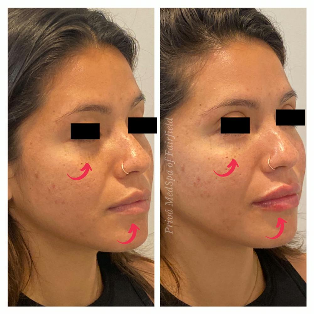 Tear Trough Fillers Before & After Gallery - Patient 45215652 - Image 2