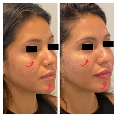 Tear Trough Fillers Before & After Gallery - Patient 45215652 - Image 2