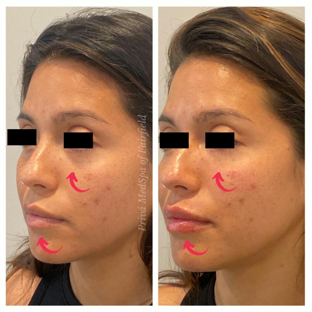Lip Augmentation Before & After Gallery - Patient 45215648 - Image 3