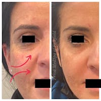 Botox/Dysport/Jeuveau Before & After Gallery - Patient 56164389 - Image 1