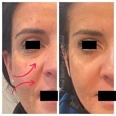 Botox/Dysport/Jeuveau Before & After Gallery - Patient 56164389 - Image 1