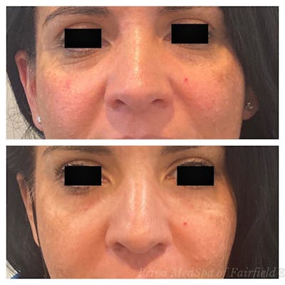 Botox/Dysport/Jeuveau Before & After Gallery - Patient 56164389 - Image 2