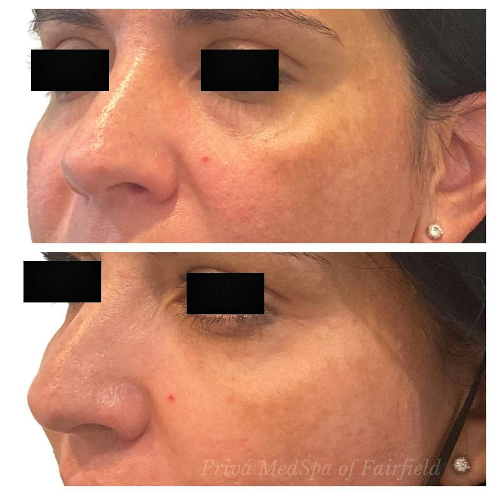 Botox/Dysport/Jeuveau Before & After Gallery - Patient 56164389 - Image 3