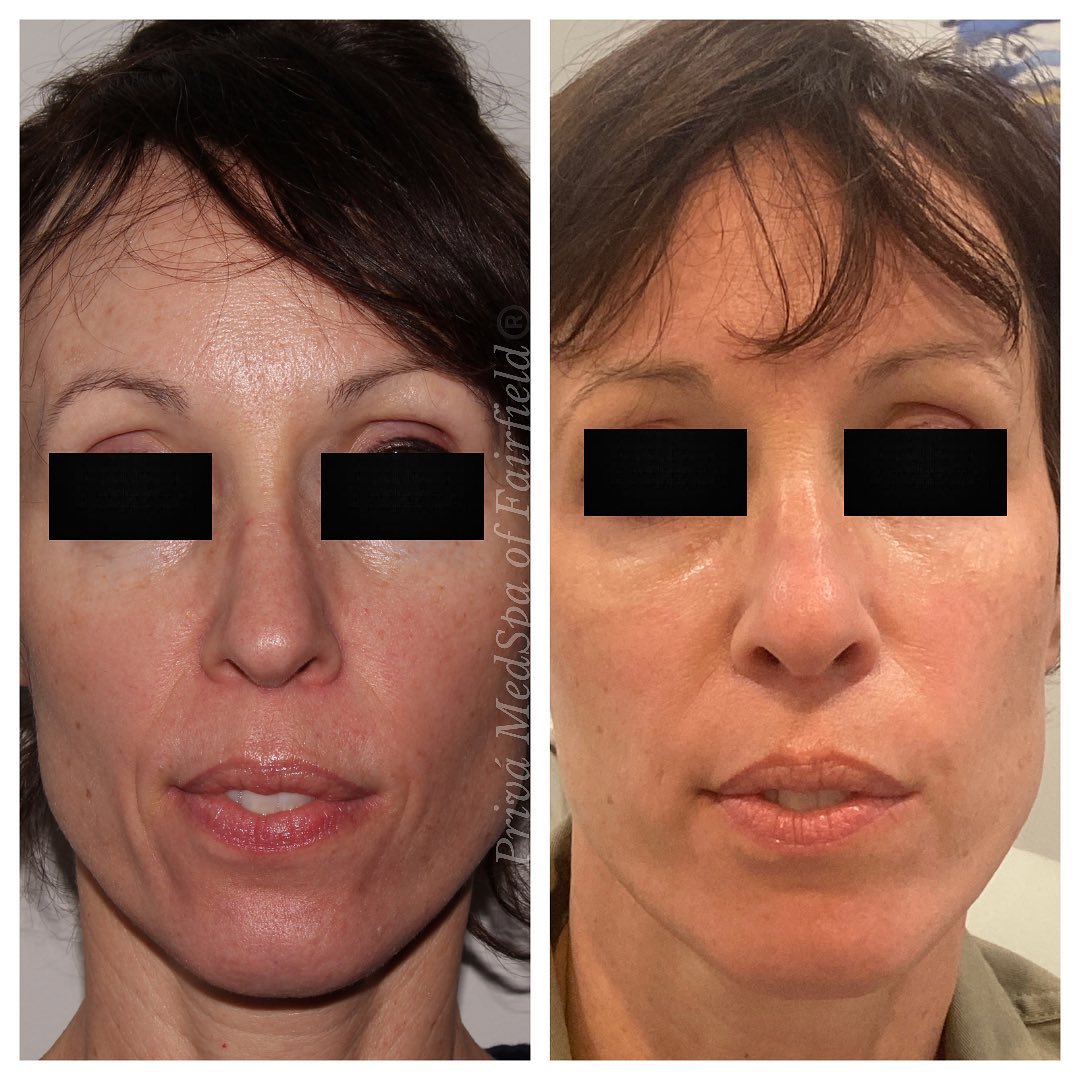 Restylane Before & After procedure