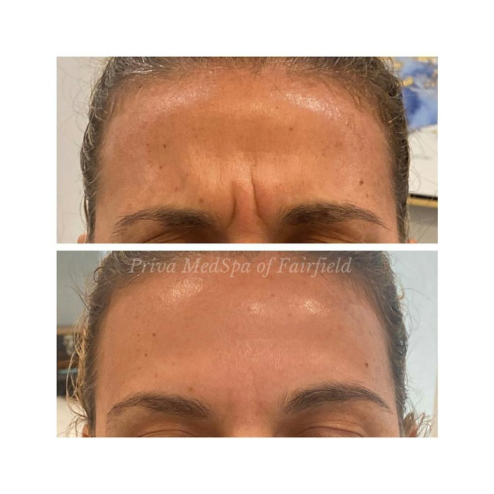 Botox/Dysport/Jeuveau Before & After Gallery - Patient 63993066 - Image 1