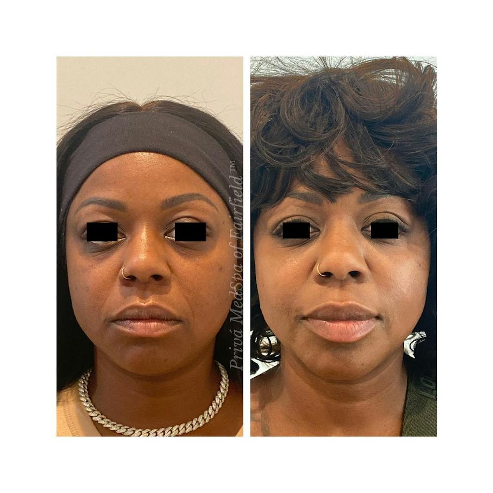 Full Face Rejuvenation Before & After Gallery - Patient 63993093 - Image 1
