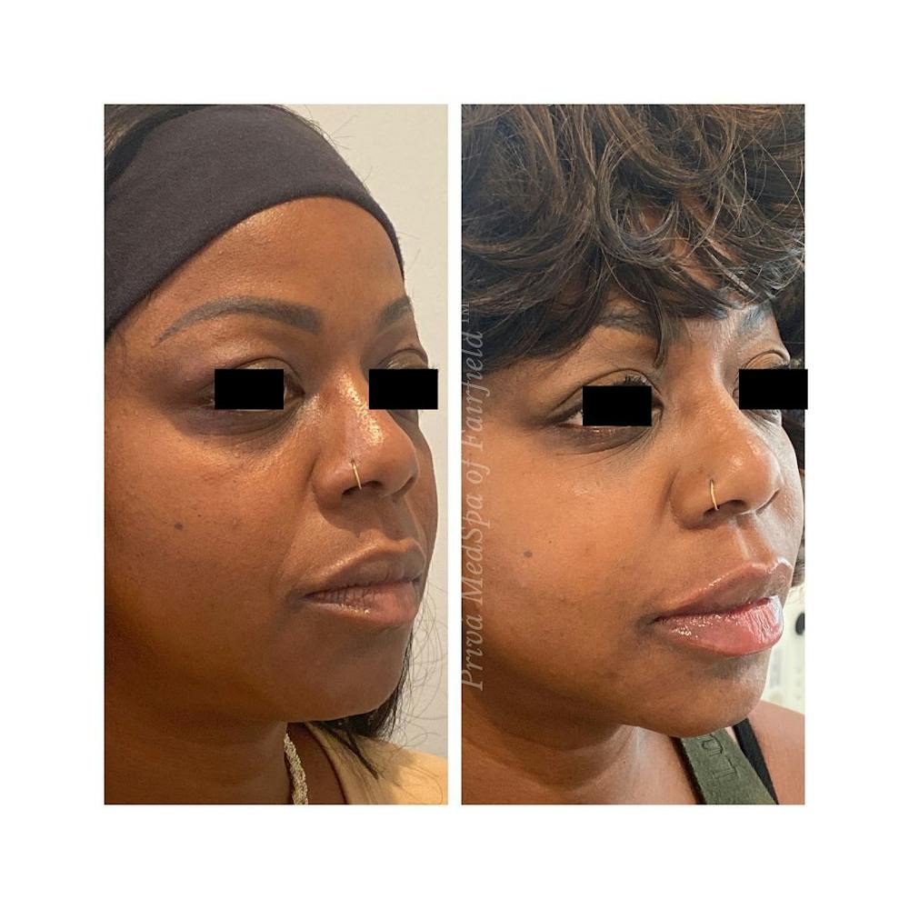 Tear Trough Fillers Gallery - Patient 63993103 - Image 2