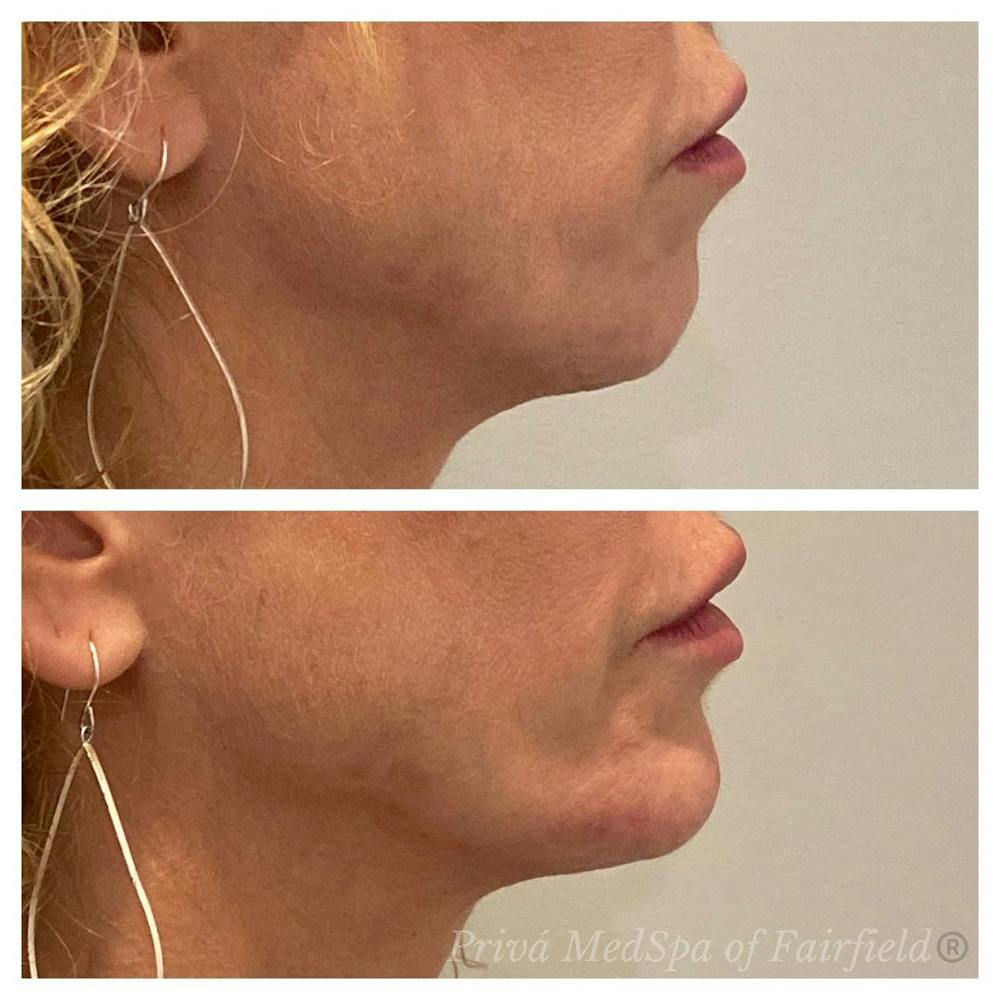 Jawline Contouring  Before & After Gallery - Patient 63993119 - Image 1