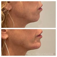 Jawline Contouring  Before & After Gallery - Patient 63993119 - Image 1