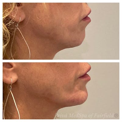 Jawline Contouring  Before & After Gallery - Patient 63993119 - Image 1