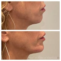 Jawline Contouring  Gallery - Patient 63993119 - Image 1