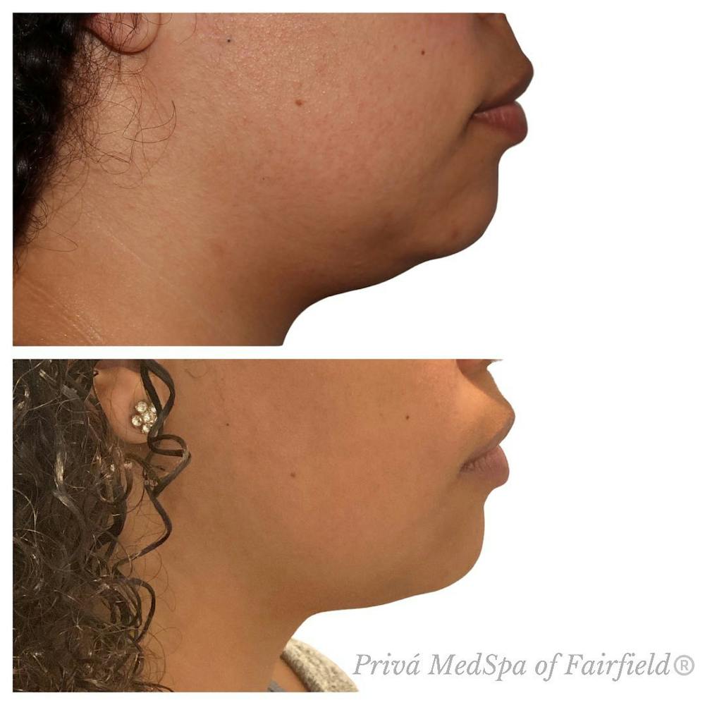 Kybella Before & After Gallery - Patient 63993134 - Image 2