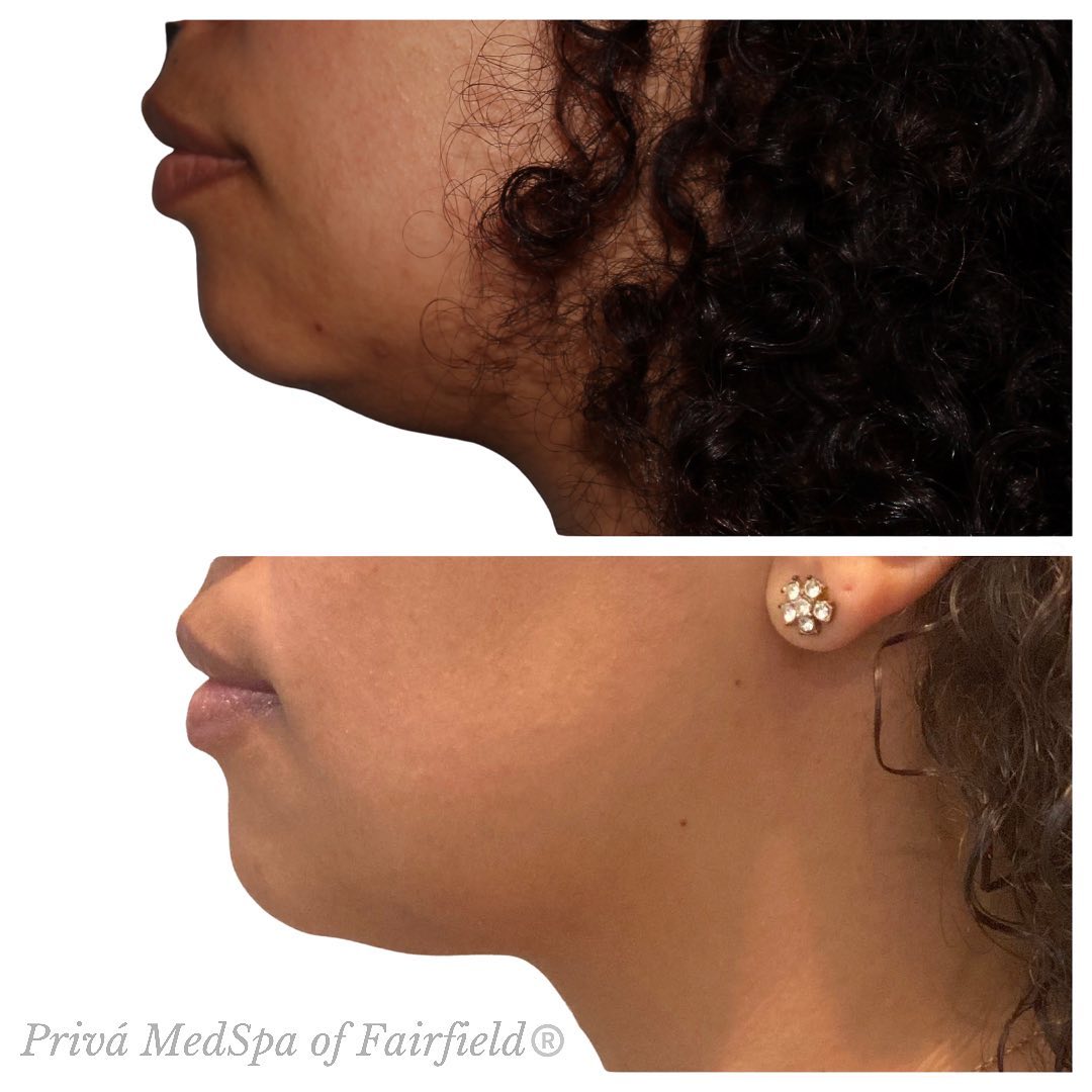 Kybella Before and After Photos