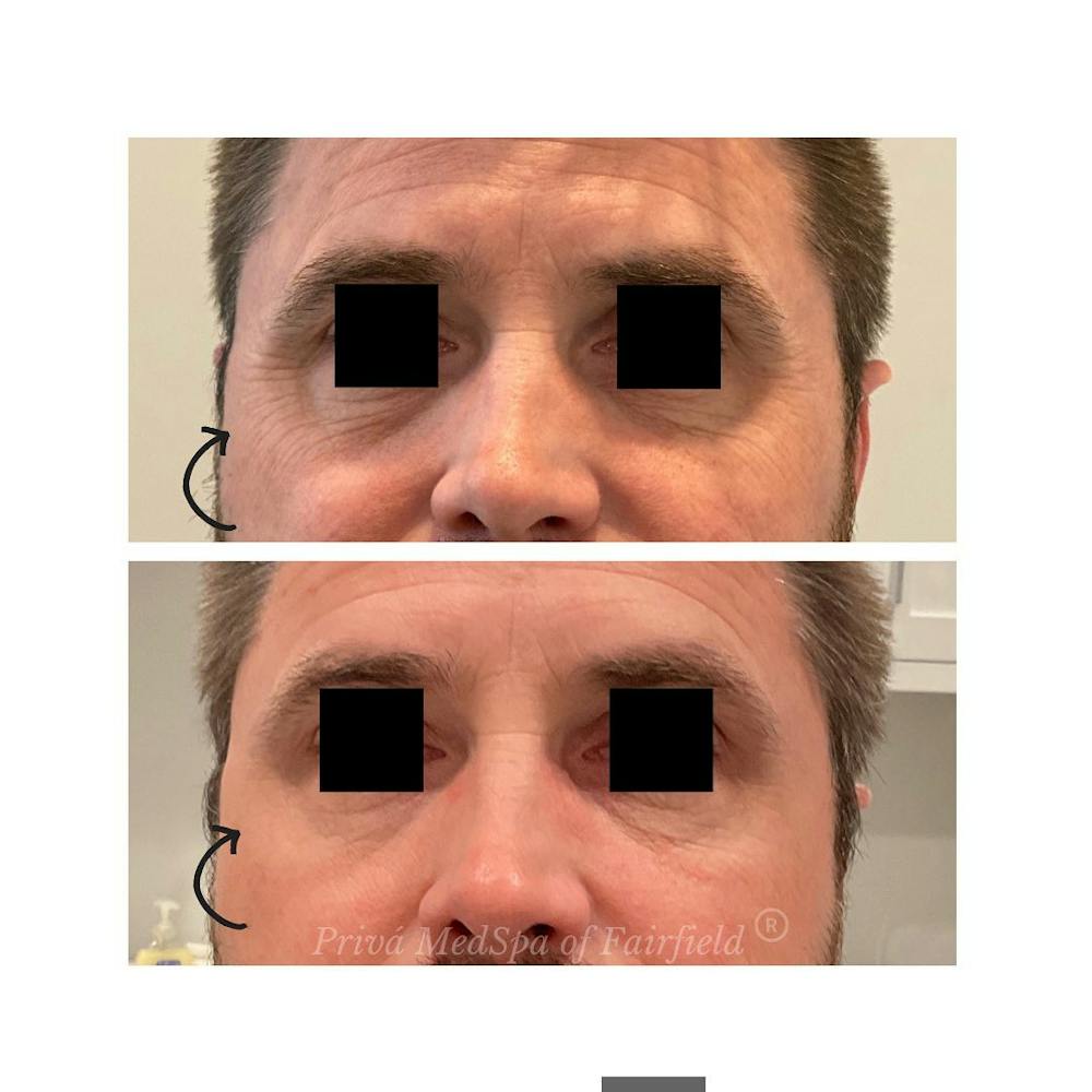 Botox/Dysport/Jeuveau Before & After Gallery - Patient 122245026 - Image 1