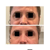 Botox/Dysport/Jeuveau Before & After Gallery - Patient 122245026 - Image 1