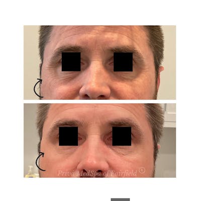 Botox/Dysport/Jeuveau Before & After Gallery - Patient 122245026 - Image 1