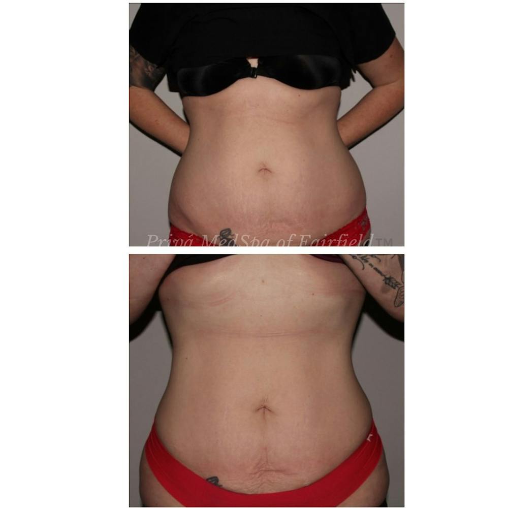 Emsculpt Neo®  Before & After Gallery - Patient 122245061 - Image 1