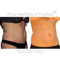 Emsculpt Neo®  Before & After Gallery - Patient 122245074 - Image 1