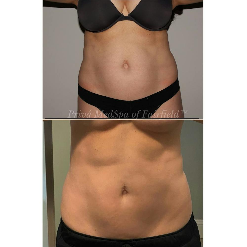 Emsculpt Neo®  Before & After Gallery - Patient 122245079 - Image 1