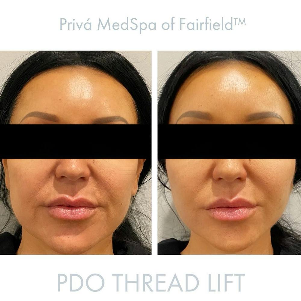 PDO Threadlift  Before & After Gallery - Patient 122245092 - Image 1