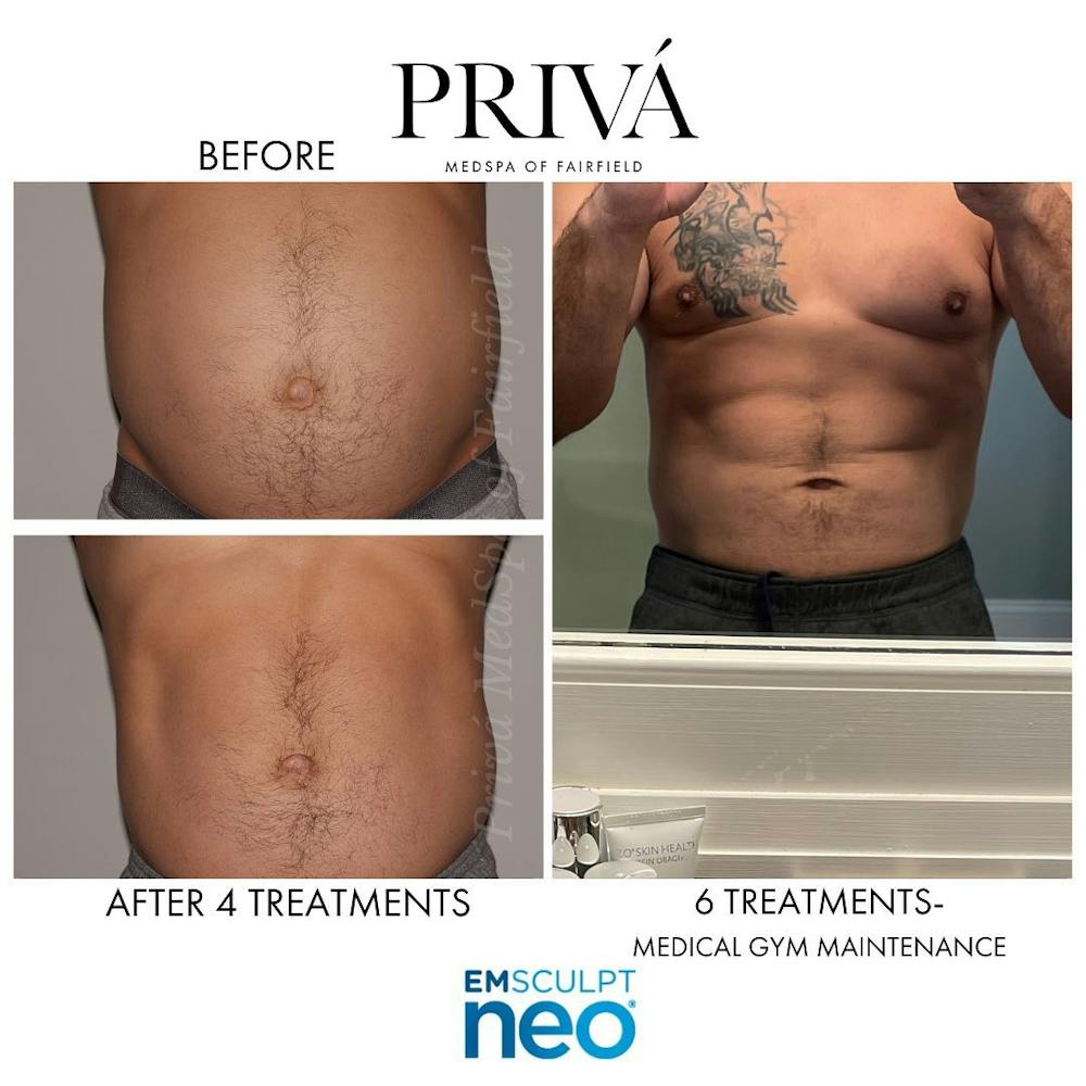 Emsculpt Neo®  Before & After Gallery - Patient 122245111 - Image 1