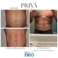 Emsculpt Neo®  Before & After Gallery - Patient 122245111 - Image 1