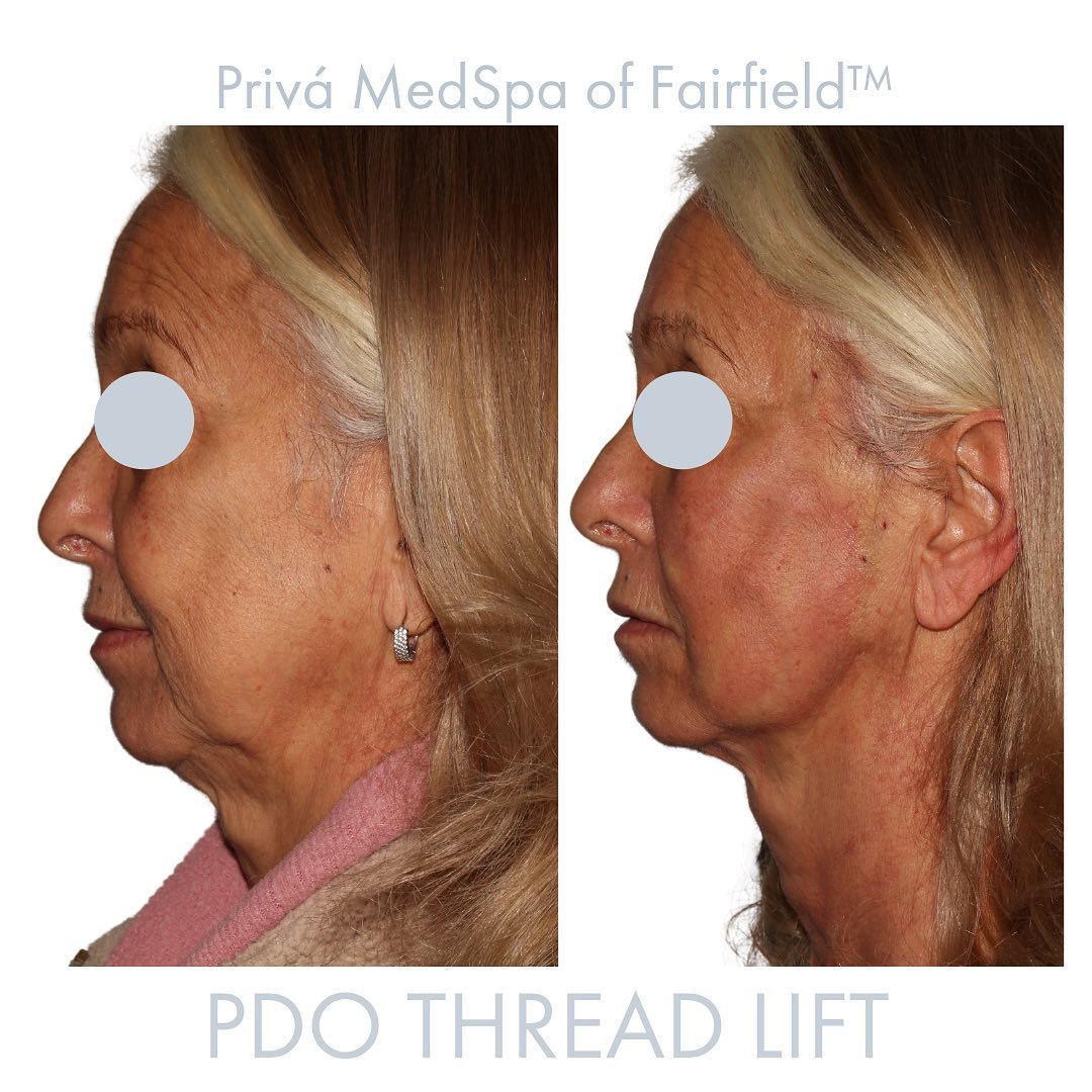 PDO Thread Lift Before & Afters