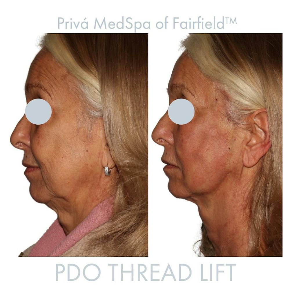 PDO Threadlift  Before & After Gallery - Patient 122245114 - Image 1