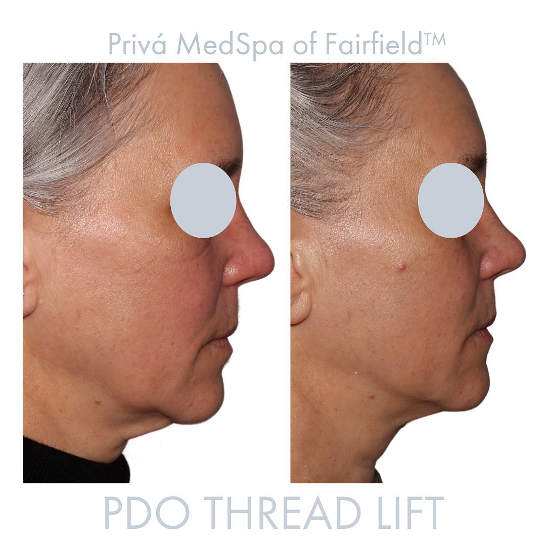 PDO Thread Lift Before & Afters