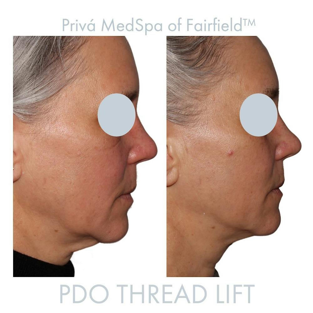 PDO Threadlift  Before & After Gallery - Patient 122245118 - Image 1