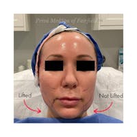 PDO Threadlift  Before & After Gallery - Patient 141066750 - Image 1