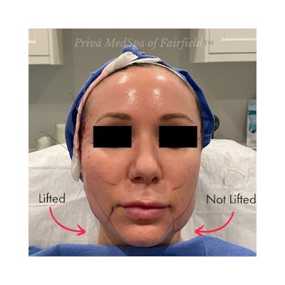 PDO Threadlift  Before & After Gallery - Patient 141066750 - Image 1