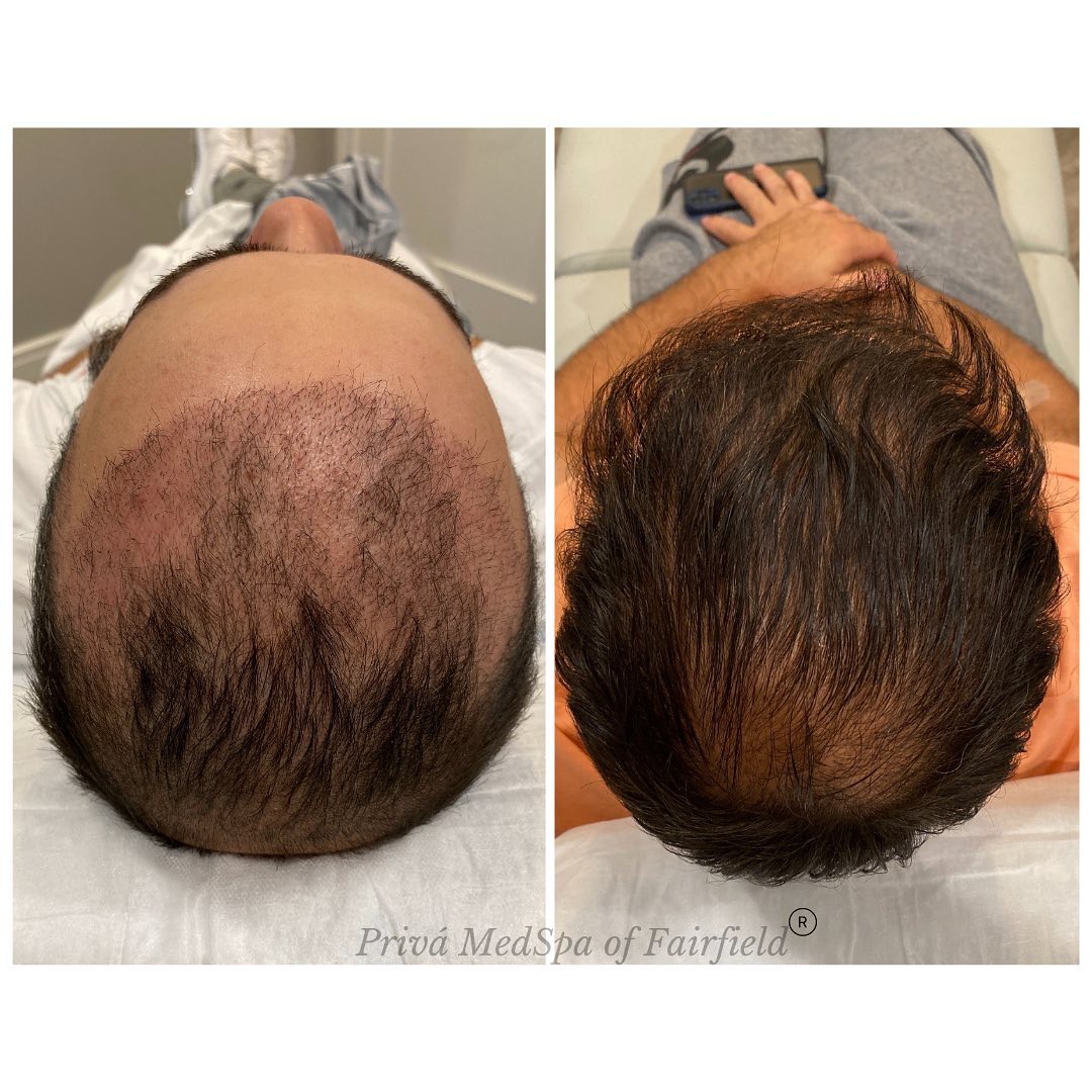 Hair Restoration Photos